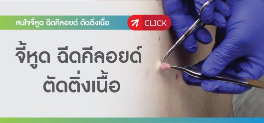 จี้หูด ฉีดคีลอยด์ ตัดติ่งเนื้อ